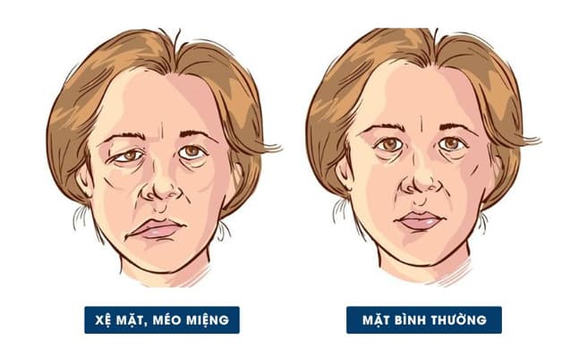 Cách nhận biết dấu hiệu đột quỵ - quan sát sự mất cân đối giữa 2 bên mặt người bệnh.