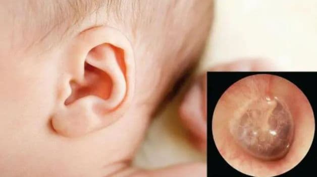 Cách trị viêm tai giữa cho trẻ cần nhờ bác sĩ