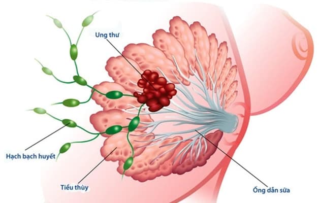 Carcinoma tuyến vú là gì - Ung thư vú có tỷ lệ mắc hàng đầu ở nữ giới (chiếm 24,5% trên tổng số các bệnh ung thư - theo Globocan 2020).