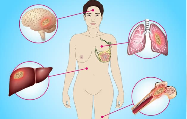 Việc các tế bào ung thư xâm lấn và lây lan trong cơ thể được gọi là di căn.