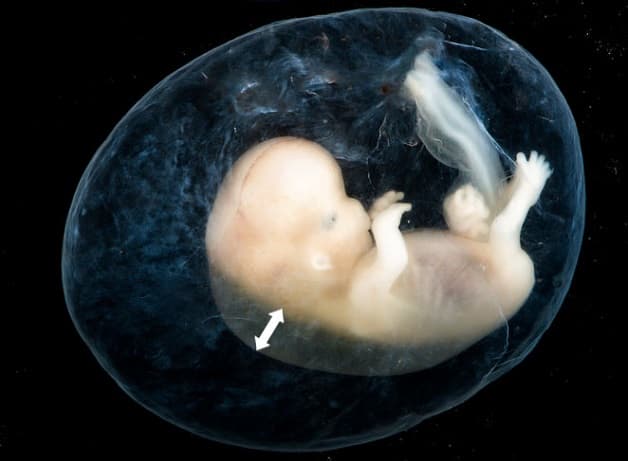 Đo độ mờ da gáy giúp đánh giá thai nhi có nguy cơ mắc hội chứng Down hay các dị tật nhiễm sắc thể khác không