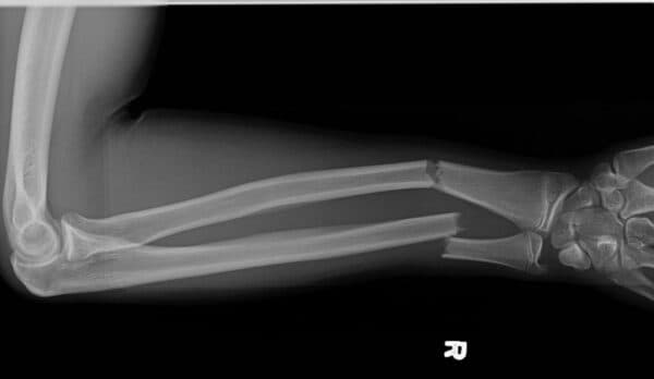 Kỹ thuật sơ cứu phụ thuộc và dạng xương gãy