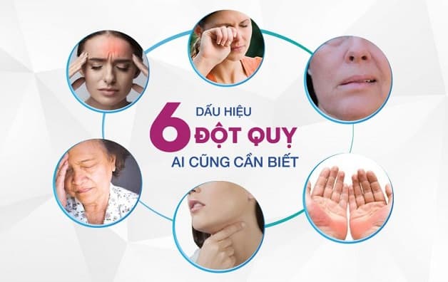 Dấu hiệu đột quỵ thường gặp
