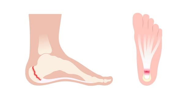 viêm tủy xương gót