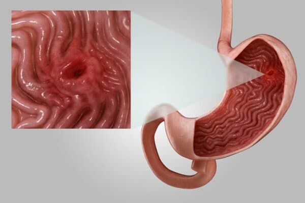 Bệnh viêm loét dạ dày