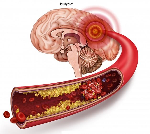 Nguyên nhân gây đột quỵ khi còn trẻ