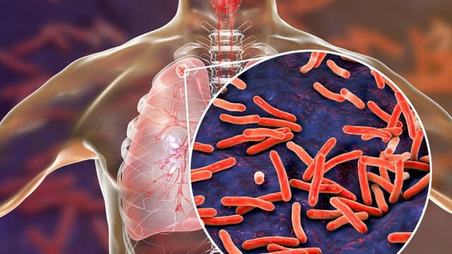 Tìm hiểu về đường lây bệnh lao phổi và cách phòng tránh