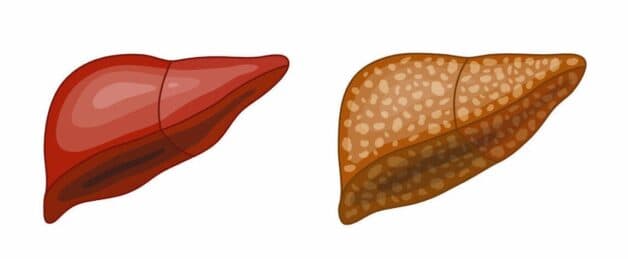 Gan nhiễm mỡ trung bình là gì?