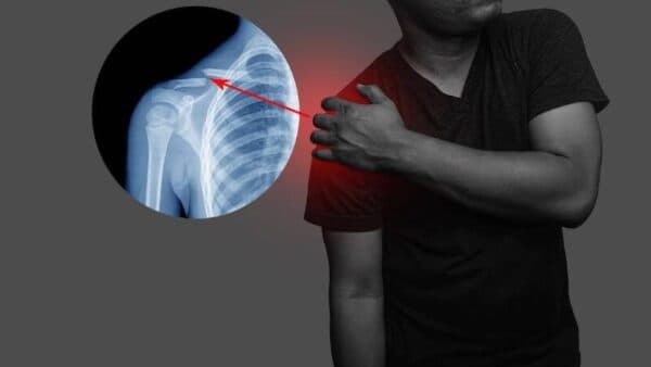 Triệu chứng gãy xương đòn