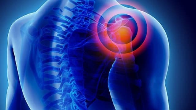 Nguyên nhân gãy xương đòn vai và cách điều trị