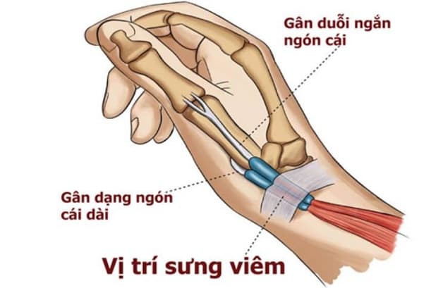 Hội chứng De Quervain là gì?