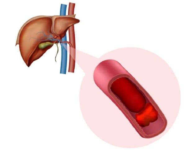 Chỉ định và chống chỉ định trong nút mạch ung thư gan