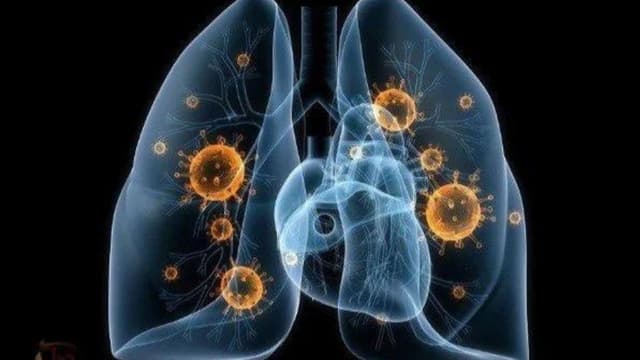 Tác hại của bệnh lao phổi và những lưu ý trong điều trị