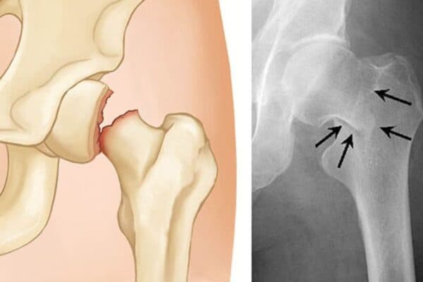 Mổ thay khớp háng là gì?