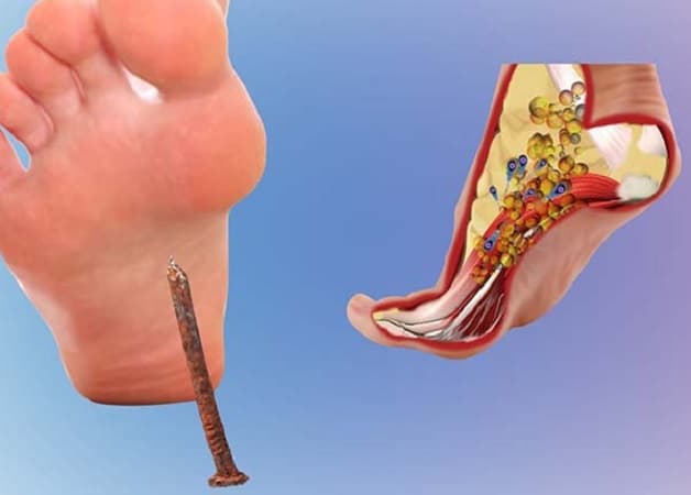 mũi uốn ván bao nhiêu tiền