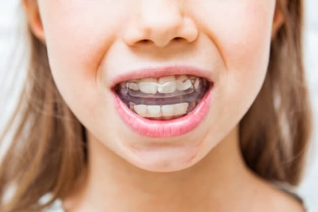 Niềng răng tháo lắp cho trẻ