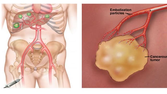 Nút mạch gan và những thông tin quan trọng cần biết