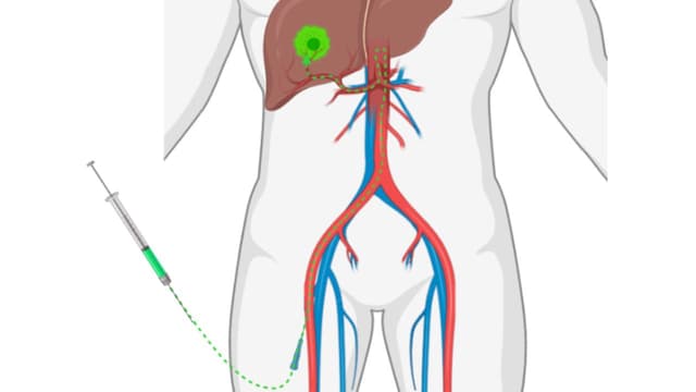 Quy trình thực hiện kỹ thuật nút mạch điều trị ung thư gan