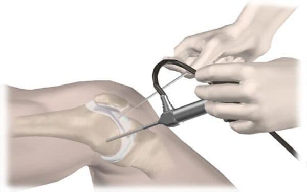 Quy trình các bước phẫu thuật nội soi khớp gối?