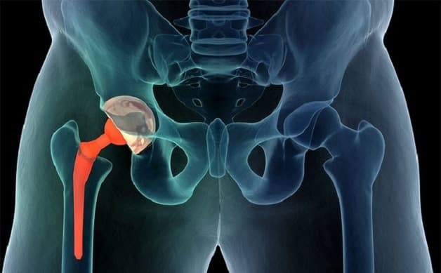 Phẫu thuật thay khớp háng