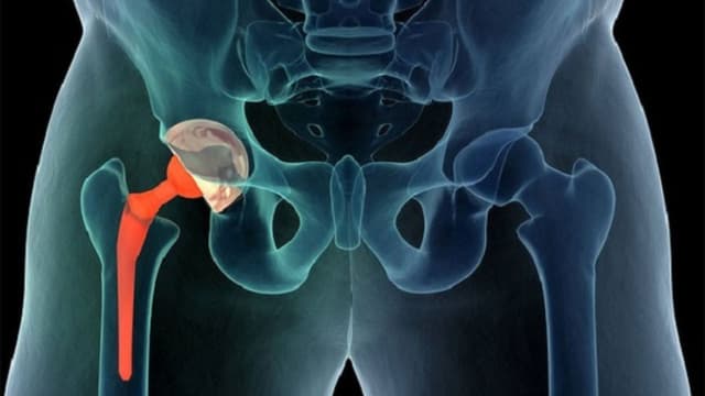 Tìm hiểu thông tin phẫu thuật thay khớp háng 