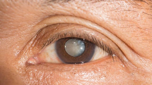 Cách chăm sóc sau khi mổ cườm khô và lưu ý