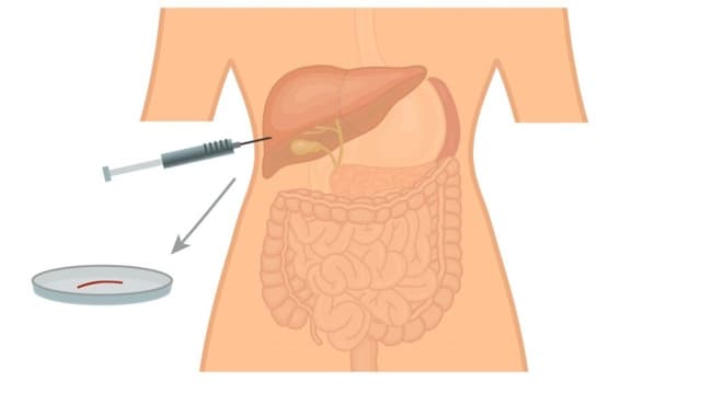 Tìm hiểu về sinh thiết gan dưới hướng dẫn siêu âm