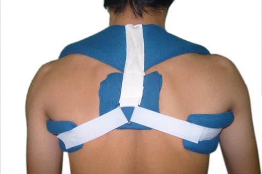 Phương pháp băng số 8 để cố định xương đòn gãy