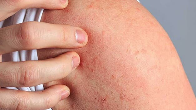 Sốc phản vệ tiêm vacxin ở mức độ nhẹ có thể thấy xuất hiện mày đay, ngứa da