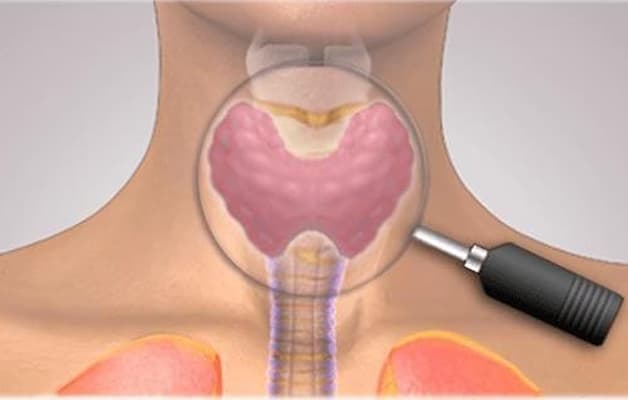 Suy tuyến giáp là gì - Suy giáp là một cách gọi khác của suy giảm chức năng tuyến giáp. 