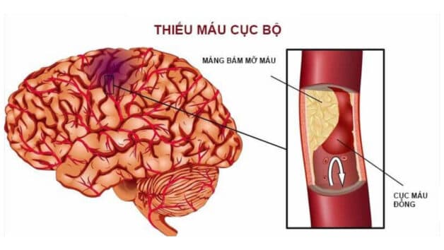 Hình ảnh đột quỵ thiếu máu cục bộ