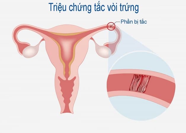 Tắc ống dẫn trứng có thể là nguyên nhân dẫn đến chửa ngoài tử cung