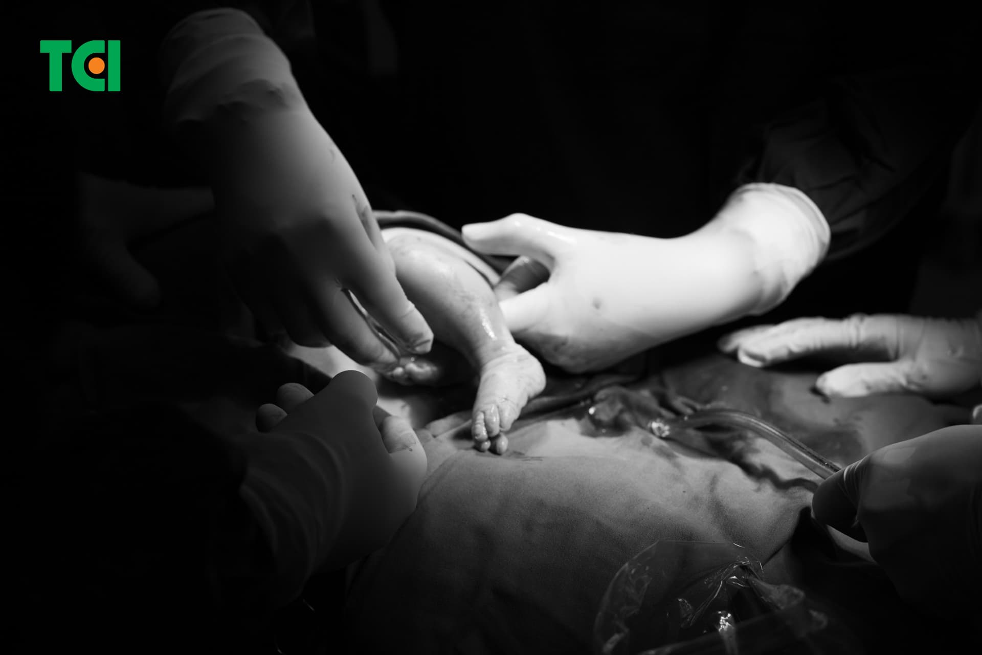 Bác sĩ thực hiện phẫu thuật sinh mổ cho chị Hiền thai ngôi ngược và dây rốn bám mép, dây rốn quấn cổ hai vòng