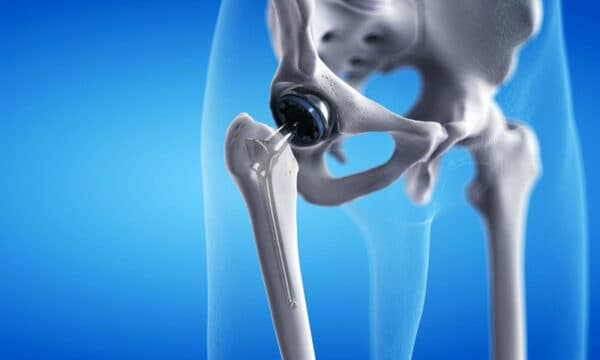 Phẫu thuật thay khớp háng