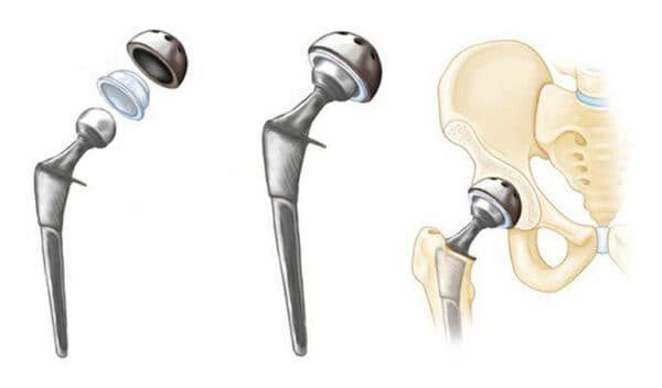 Thay khớp háng nhân tạo toàn phần