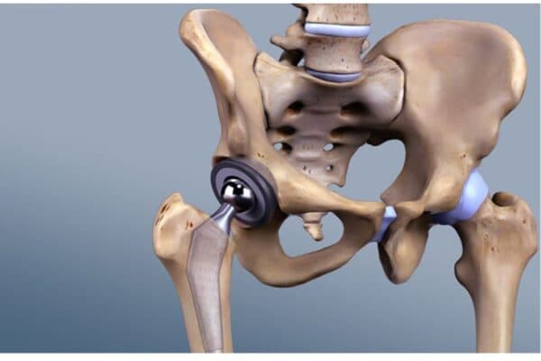 Độ bền của khớp háng nhân tạo