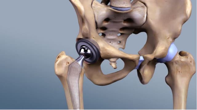 Thay khớp háng nhân tạo có độ bền trong bao lâu?