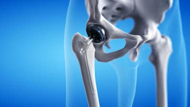 Thay khớp háng ở đâu tốt? Cần lực chọn theo tiêu chí gì?