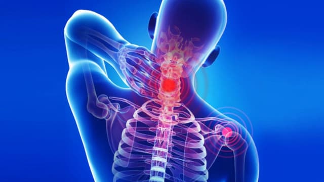 Cơ chế thoái hóa đốt sống cổ gây thiếu máu não