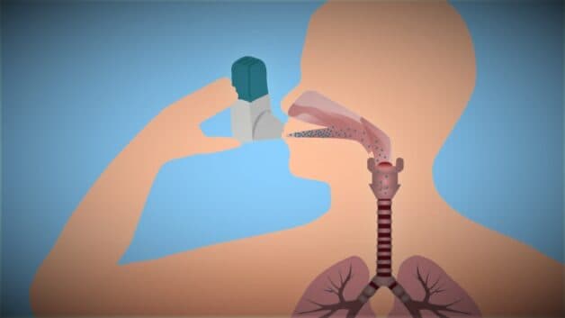 Các loại thuốc hít điều trị hen suyễn hay hen phế quản