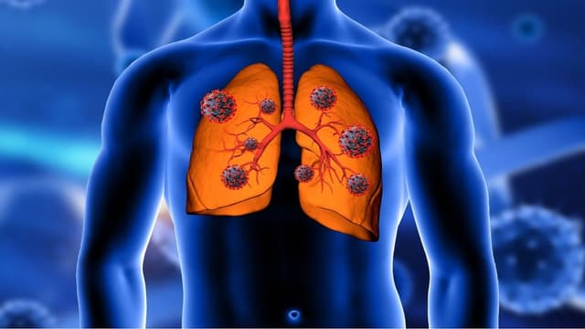 Tiên lượng ung thư phổi di căn và cách điều trị