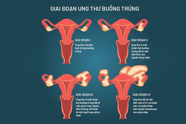 ung thư buồng trứng