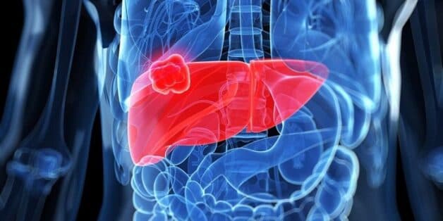 điều trị ung thư gan huyết khối tĩnh mạch cửa