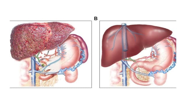 Những điều cần biết về ung thư gan huyết khối tĩnh mạch cửa
