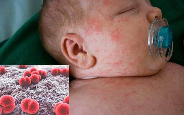 Vi khuẩn viêm não mô cầu Neisseria meningitidis có nhiều chủng, bao gồm: A, B, C, D, W-135...