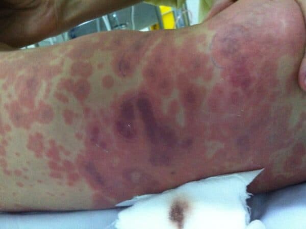 Bệnh viêm não mô cầu rất nguy hiểm và để lại biến chứng nặng nề.