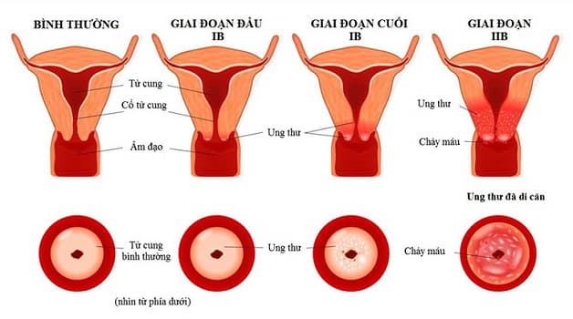 Ung thư cổ tử cung là một vấn đề sức khỏe nghiêm trọng