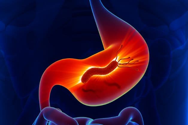 Nhiễm khuẩn HP có thể gây ra nhiều bệnh lý dạ dày và tiêu hóa