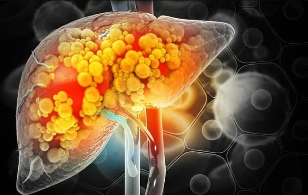 Viêm gan nhiễm mỡ là bệnh gì?