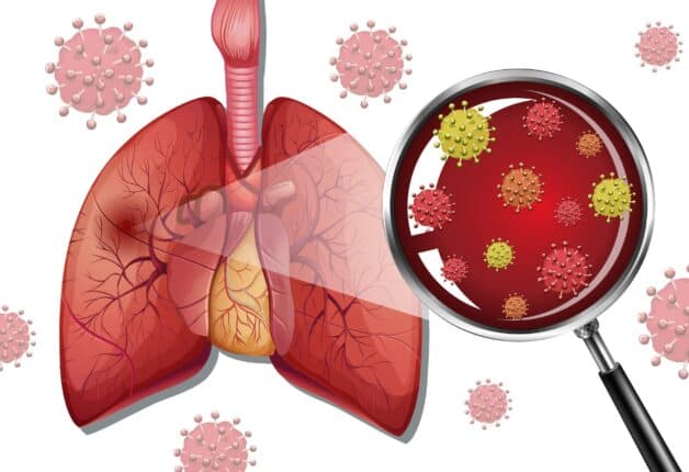 Viêm phổi kẽ là bệnh không lây nhiễm